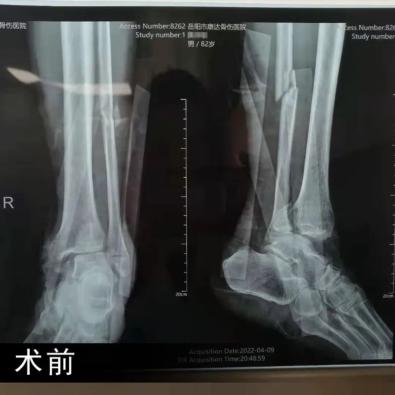 外伤致左踝开放性损伤